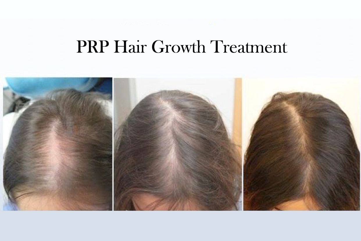 PRP Hair Growth Treatment