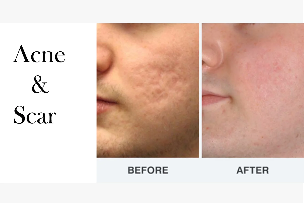 Acne Scar