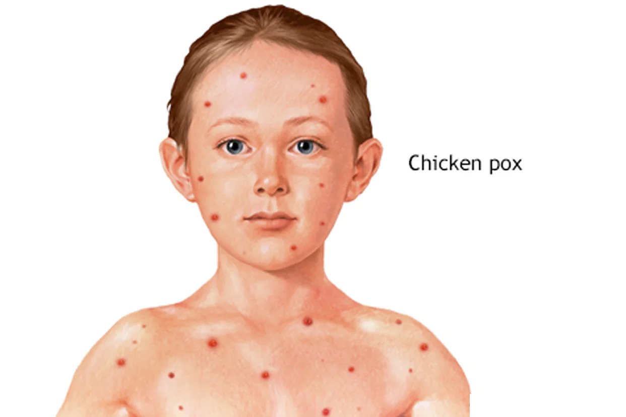 Chickenpox