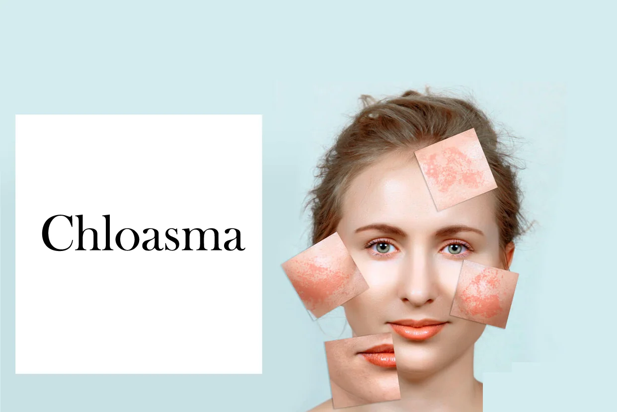 Chloasma