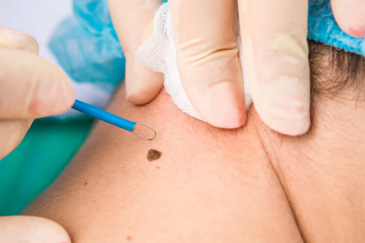 Warts & Mole Removal